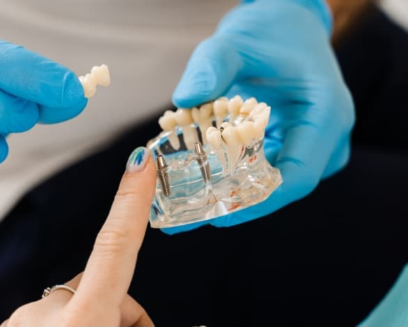 Dental Implants