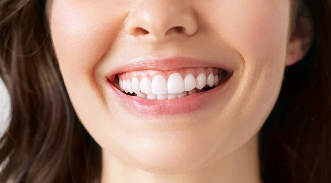 Teeth Whitening
